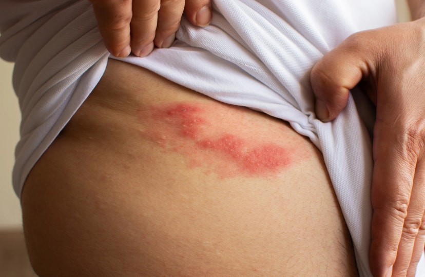 Shingles